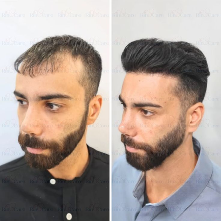 Comparação ilustrativa de densidade capilar antes e depois